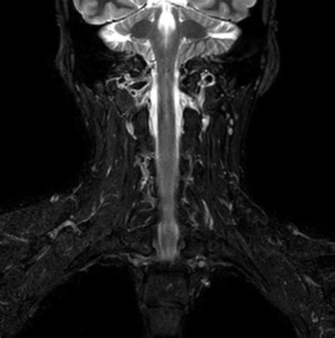 Shorten Exam Time With Compressed Sense In Cervical Spine Philips Mr