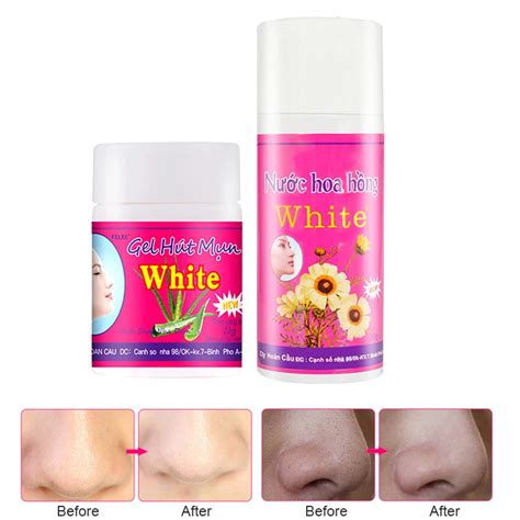 Whiteheads And Blackheads Remover