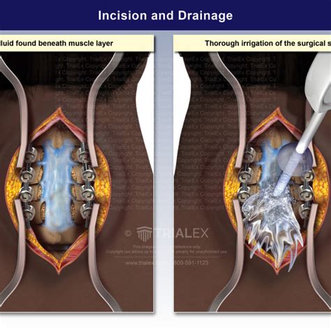 Incision And Drainage Trialexhibits Inc