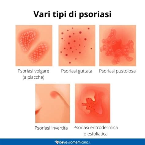 Psoriasi Sintomi Cure Cause E Trattamento