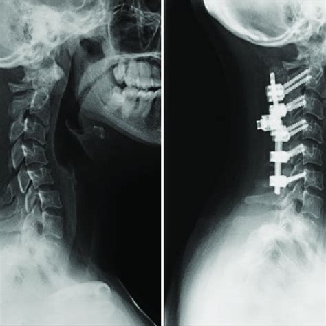 Preoperative Lateral Cervical Spine Radiograph Left Shows