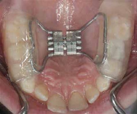 Bonded Rapid Maxillary Expansion Rme Device For The Correction Of