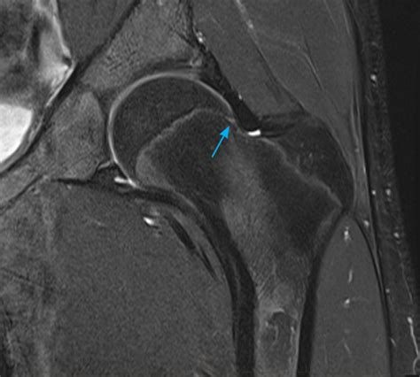 Mri Hip Paediatic Mri Series Gp Referred