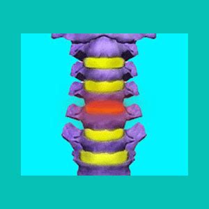 Herniated Disc C4-C5 - Herniated Disc