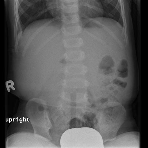 Intussusception Image