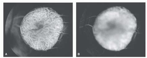 Choroidal Melanoma Fluorescein Angiography