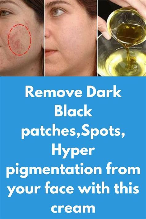 Unbelievable Remove Dark Black Patches Dark Spotshyper Pigmentation