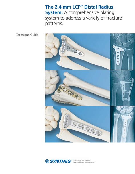 Pdf Mm Lcp Distal Radius System Technique Guide Surgical