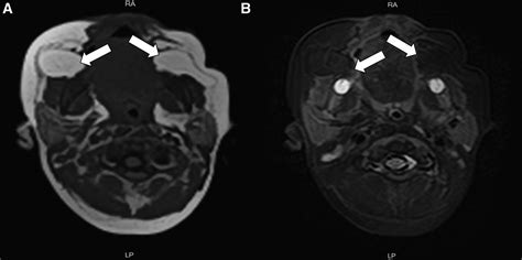 Bilateral Buccal Fat Pad Herniation The Journal Of Pediatrics