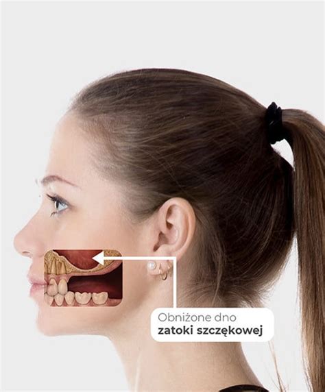 Podniesienie dna zatoki szczękowej Sopot Trójmiasto