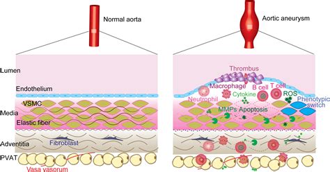 Vascular Smooth Muscle Cells In Aortic Aneurysm From Genetics To