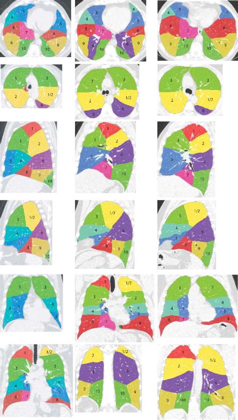 Figure From Automatic Segmentation Of Pulmonary Segments From