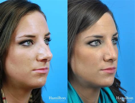 Rhinoplasty Before And After Gallery Patient 25