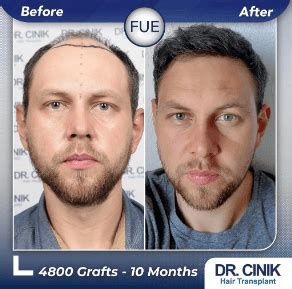 Dr Emrah Cinik Review Pricing Before After