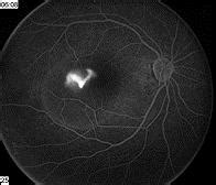 Chorioretinopathy- Retina Ophthalmology Frederick MD - Greater Potomac ...