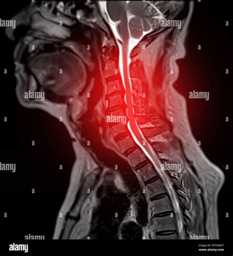 Mri Of C Spine Or Magnetic Resonance Image Of Cervical Spine Sagittal