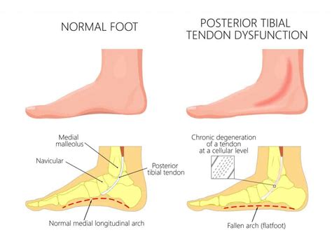 Posterior Tibial Tendonitis Diagnosis Symptoms And Treatments