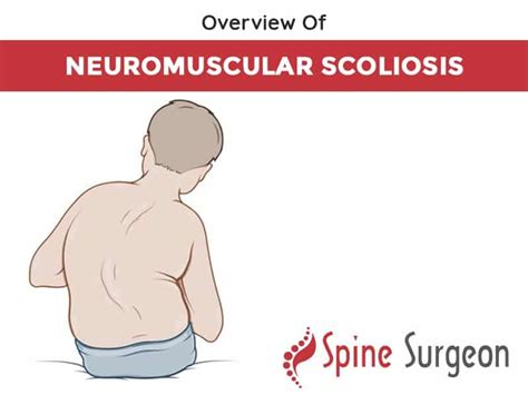 Overview Of Neuromuscular Scoliosis Spine Surgeon