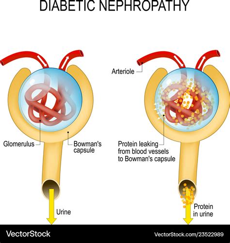 Diabetic nephropathy diabetic kidney disease Vector Image