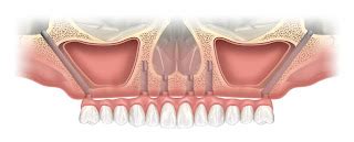 Dental Implants: Zygoma Dental Implants by Nobel biocare