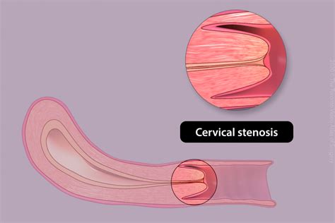 Stenosis Of Uterine Cervix Telegraph