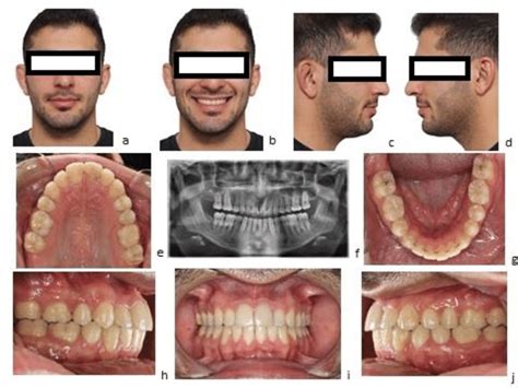 Extraoral Views Frontal At Rest A Frontal At Smile B Right And