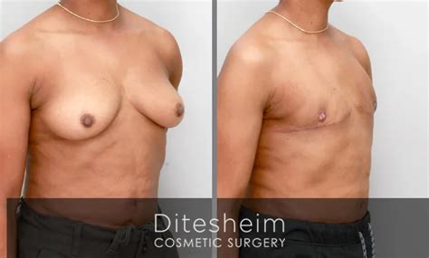 Location Charlotte NC Ditesheim Cosmetic Surgery