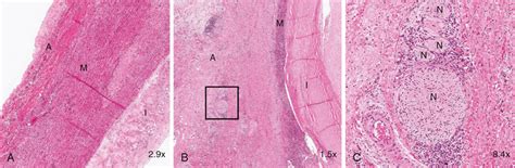 Aortic Dissection Histology