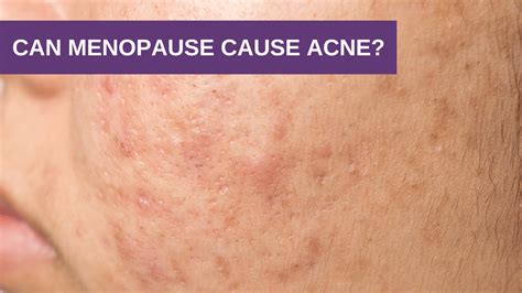 Can Menopause Cause Acne? - Genesis Gold - Menopause