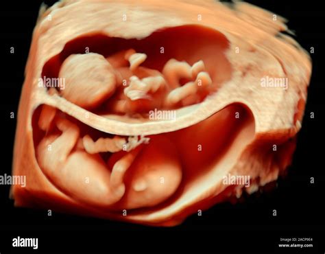 Feto De 12 Semanas De Gemelos 3 D Ecografía Tridimensional 3 D