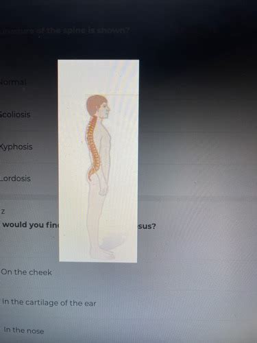 Ch 8 Cervical Spine Flashcards Quizlet