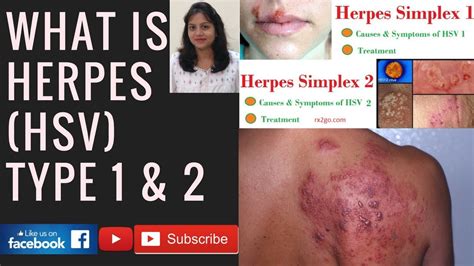 What Is Herpes Hsv Herpes Simplex Virus Human Herpesvirus 1 And 2 Youtube