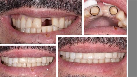 Dental Bridge Front Teeth