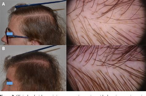 Figure 1 From Alopecia Areata Incognita And Diffuse Alopecia Areata