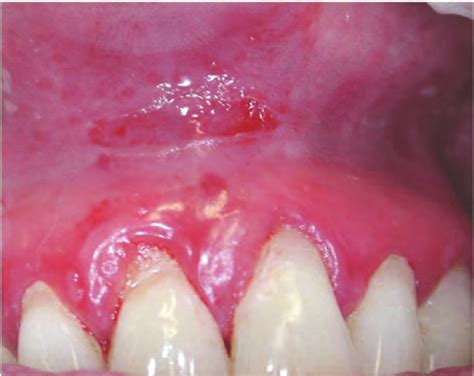 Oral Lichen Planus Gums