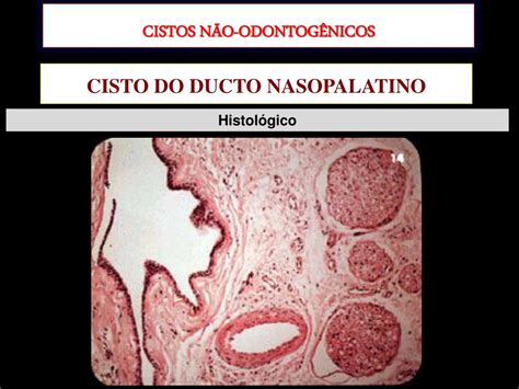 Ppt Cistos Odontog Nicos E N O Odontog Nicos Powerpoint