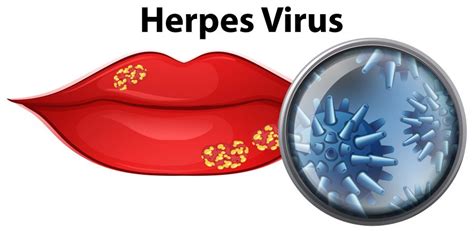 Especial Desconfianza Animado Herpes Labial Formas De Contagio Tacto