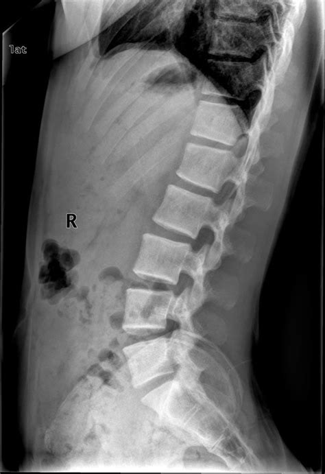 Lordosis | Pathology, X ray