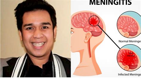 Kenali Gejala Meningitis Penyakit Yang Menimpa Olga Glenn Ashanty