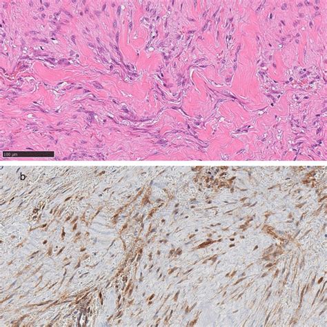 A Histopathology Showing Proliferation Of Spindle Shaped Cells