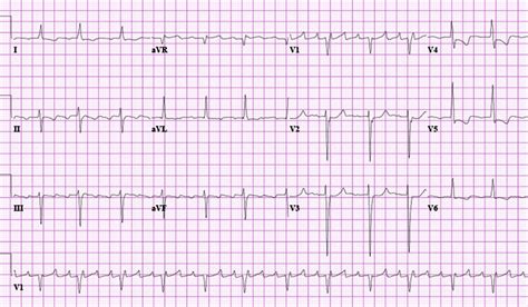 Atrial Flutter Symptoms Diagnosis And Treatment Bmj Best Practice