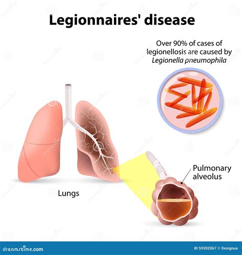 Legionnaires Disease Or Legionellosis, Legion Fever Is A Form O Stock ...