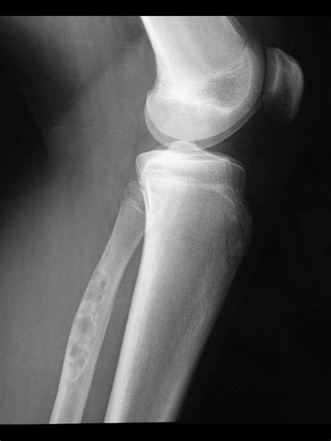 Radiografía Rodilla Fibroma No Osificante Aire Mb