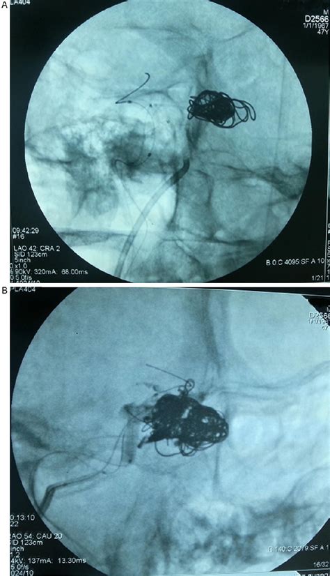 Figure From A Retrospective Analysis Of Carotid Cavernous Fistula