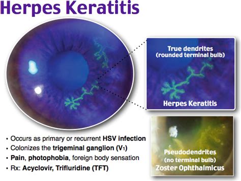 Herpes Zoster Ophthalmicus Pseudodendrite