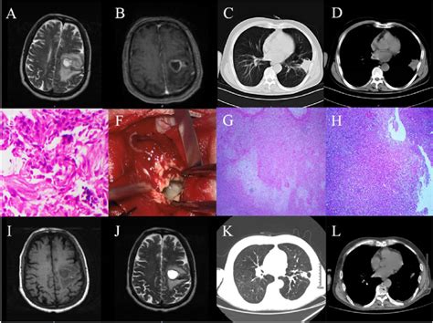 Head MRI Chest CT Scan Histopathology Of Lung Mass And Naked Eye