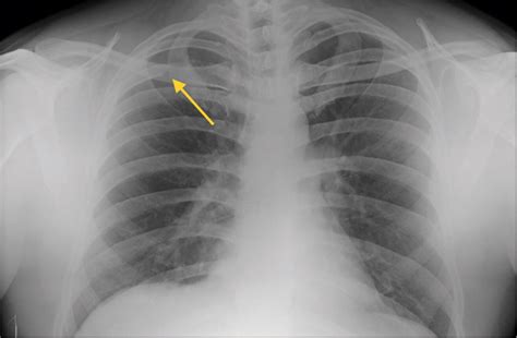 A Rare Cause Of Solitary Rib Lytic Lesion In Adult A Case Report