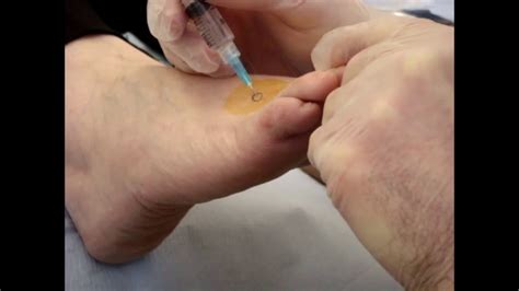 Injection Csi Technique For Stump Morton S Neuroma Youtube