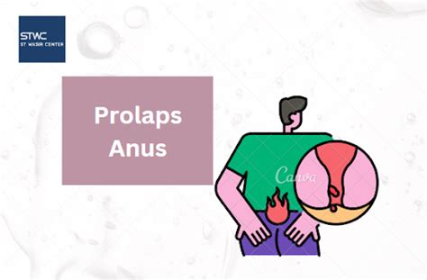 Prolaps Anus Penyebab Gejala Dan Pengobatan