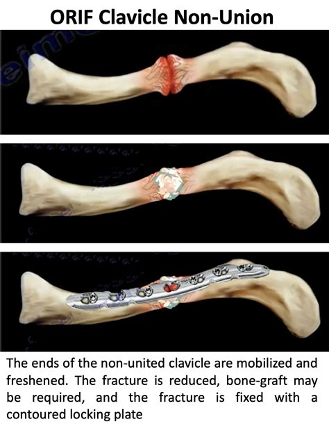 Clavicle Cambridge Shoulder